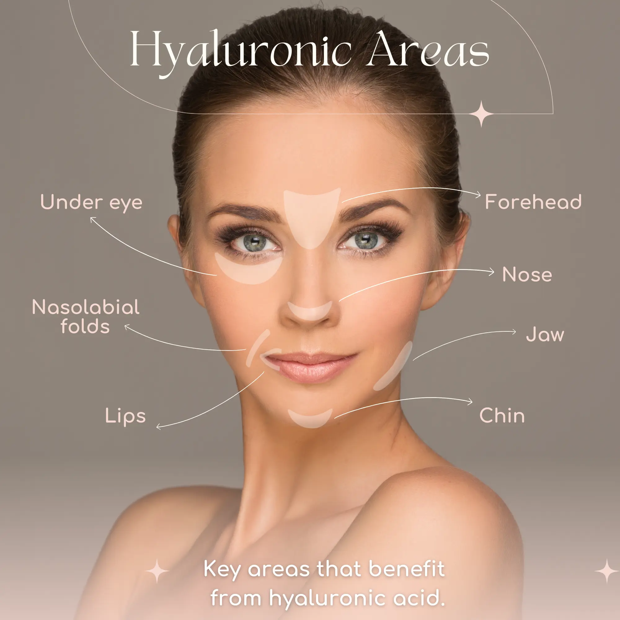 Diagram of a woman's face highlighting key areas where hyaluronic acid is applied, including the forehead, under-eye, nose, lips, chin, jaw, and nasolabial folds.